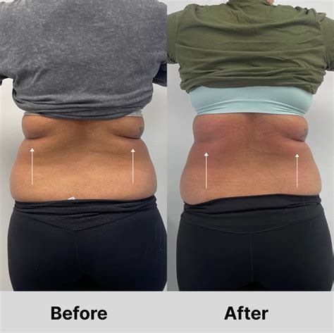 emsculpt san jose|Emsculpt Neo Transformation at Rated R Esthetics in San Jose.